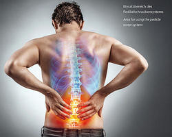 Einsatzbereich des Pedikelschraubensystems